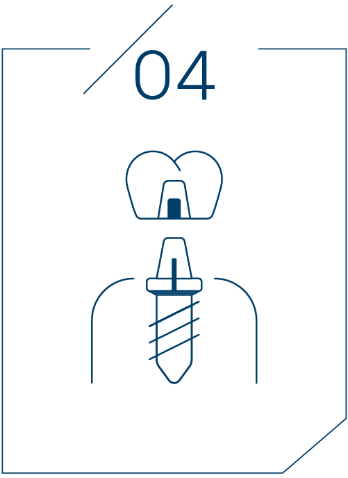 <strong>4단계 보철물 완성</strong>