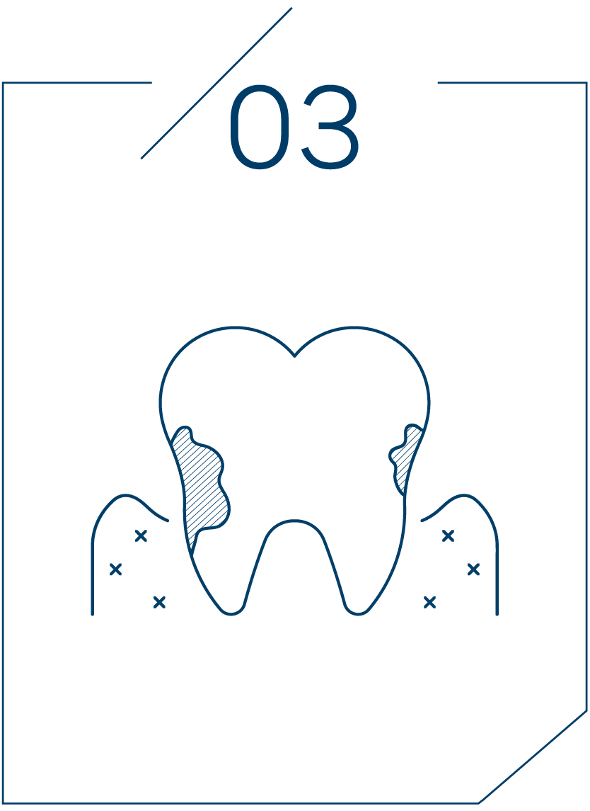 <strong>잇몸 뼈가 녹기 시작</strong>