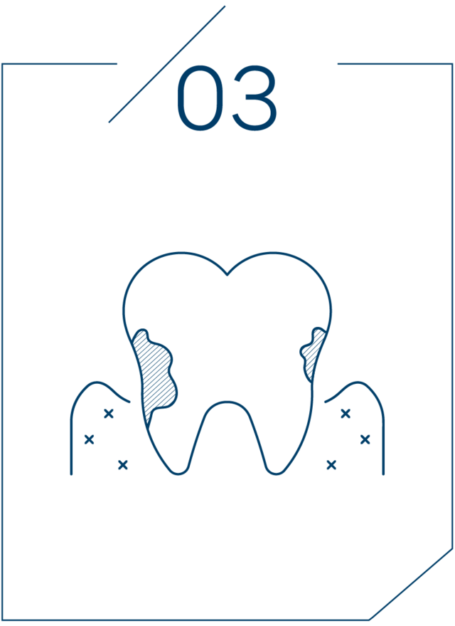 <strong>잇몸 뼈가 녹기 시작</strong>
