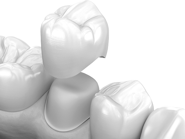 부천-연세미소애치과-크라운치료-크라운치료적응증