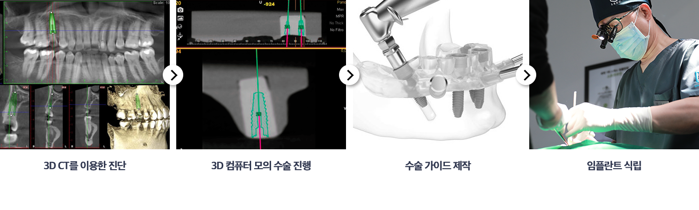네비게이션 임플란트 수술 과정