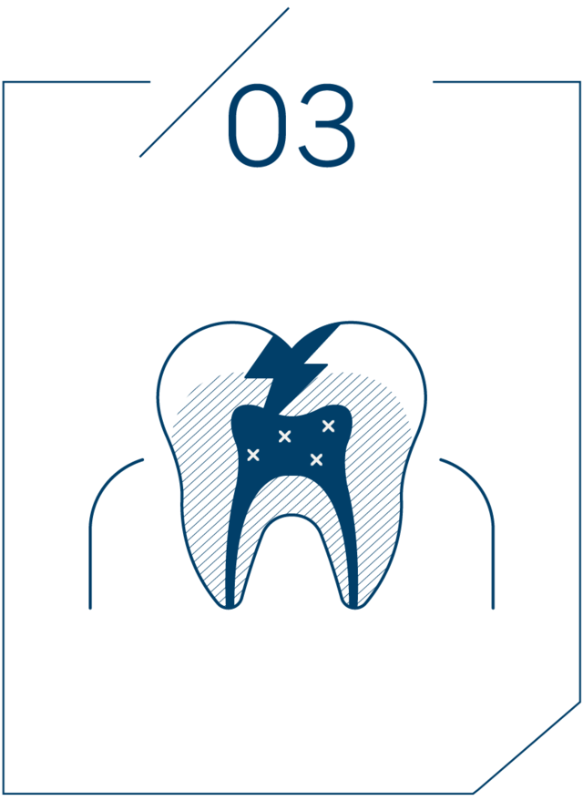 <strong>3단계 치수 충치</strong>