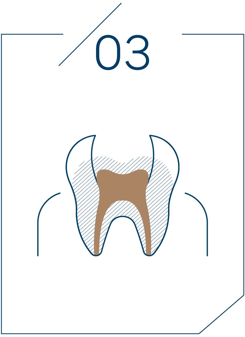 <strong>3단계 신경관 충전</strong>