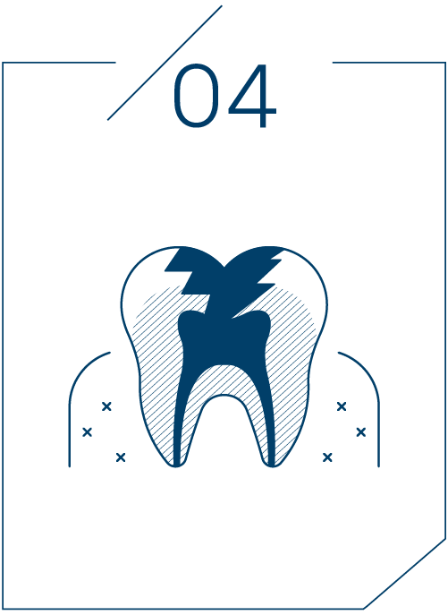 <strong>4단계 치아뿌리 충치</strong>