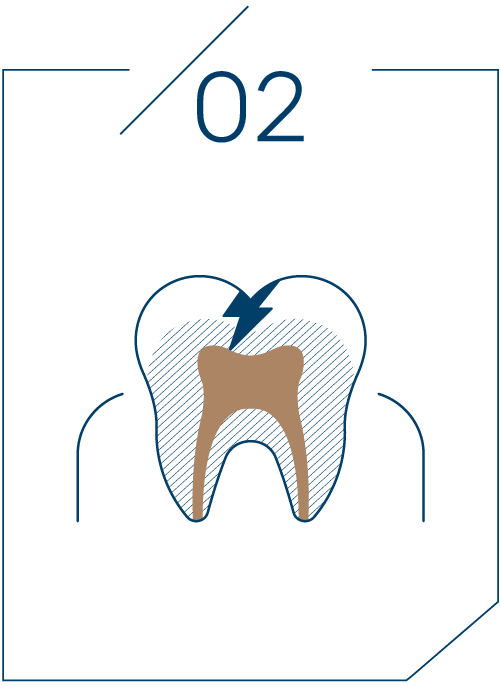 <strong>2단계 상아질 충치</strong>