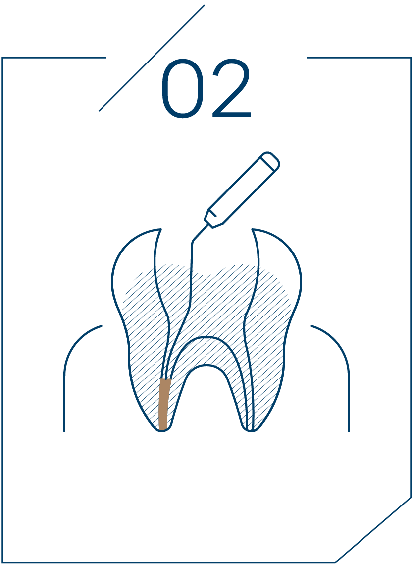 <strong>2단계 치수 제거 및 소독</strong>