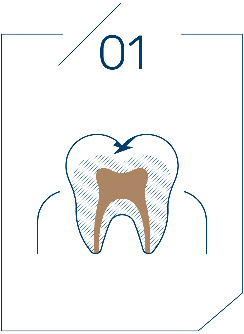 <strong>1단계 법랑질 충치</strong>