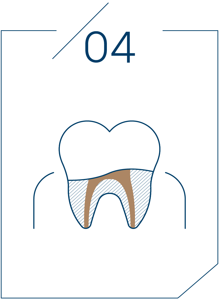 <strong>4단계 보철물 제작</strong>