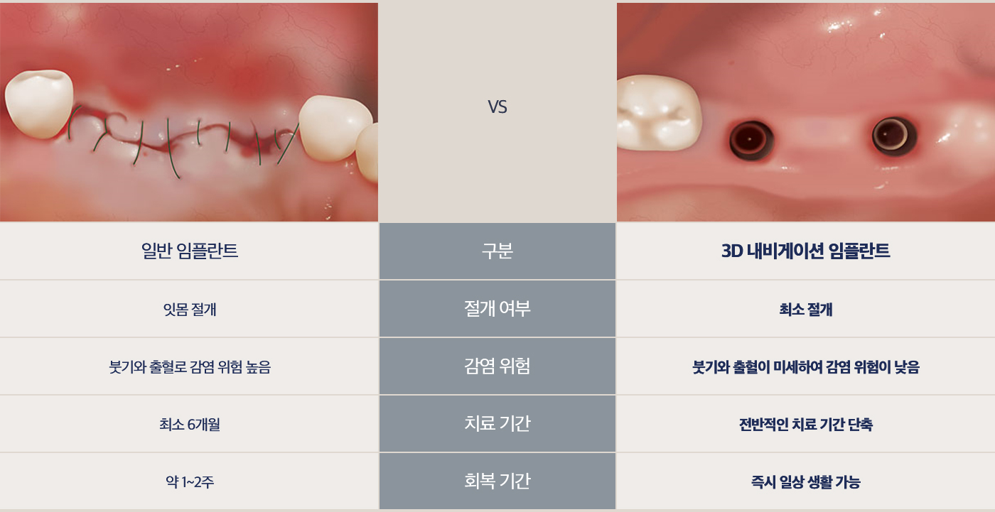 내비게이션 임플란트의 장점