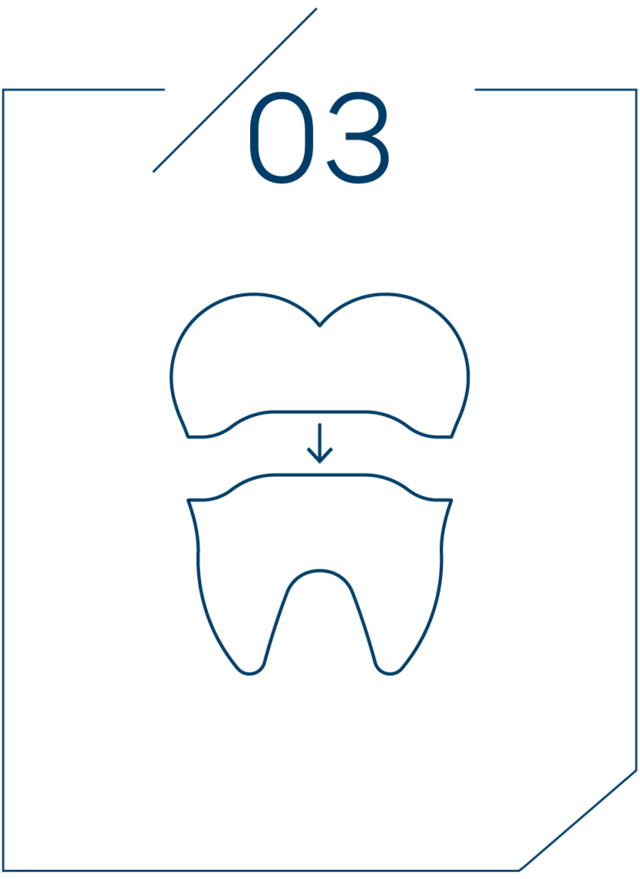 <strong>3단계 보철물 제작</strong>