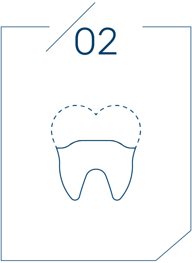 <strong>2단계 치아 삭제 및 본뜨기</strong>