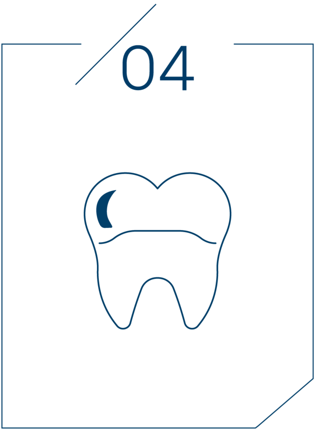 <strong>4단계 보철물 결합</strong>