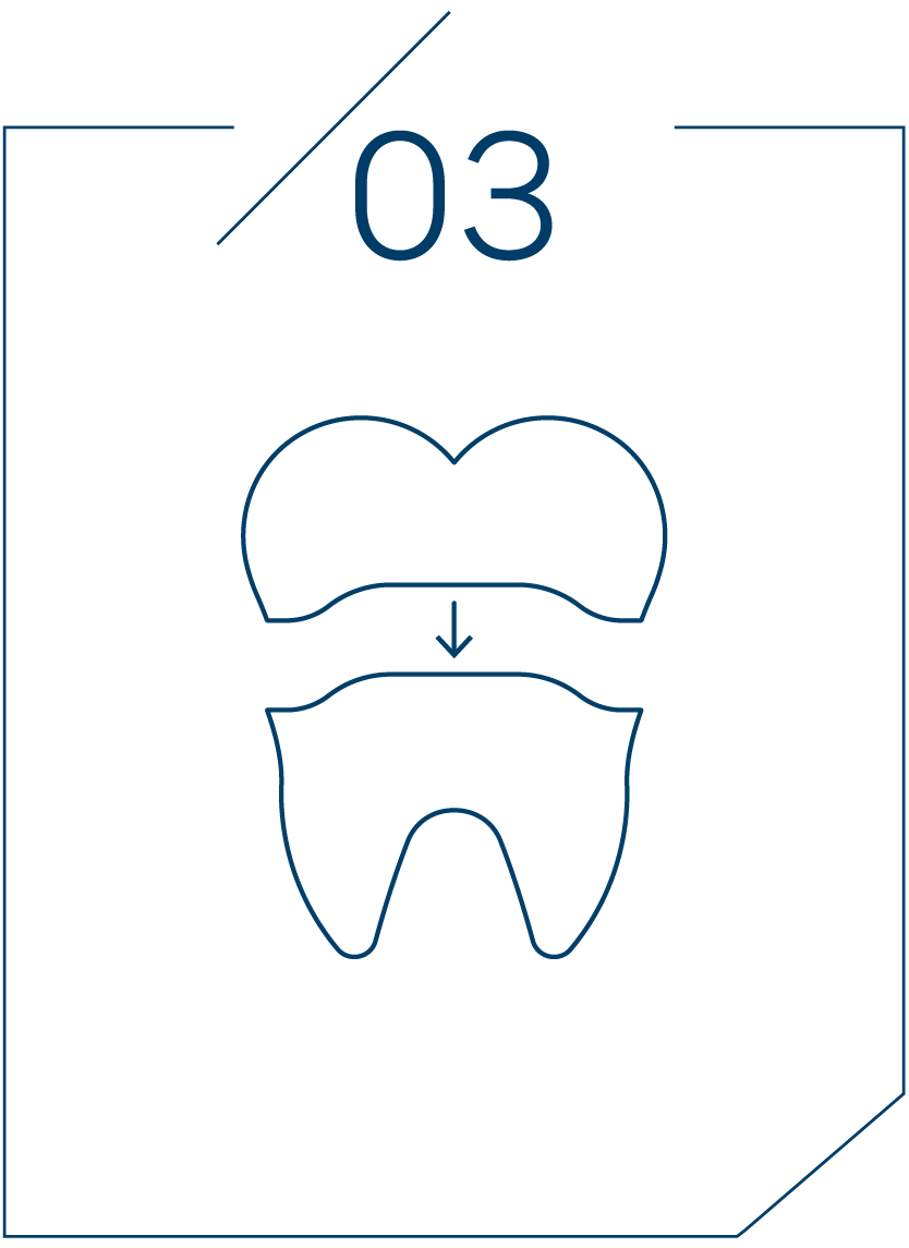 <strong>3단계 보철물 제작</strong>