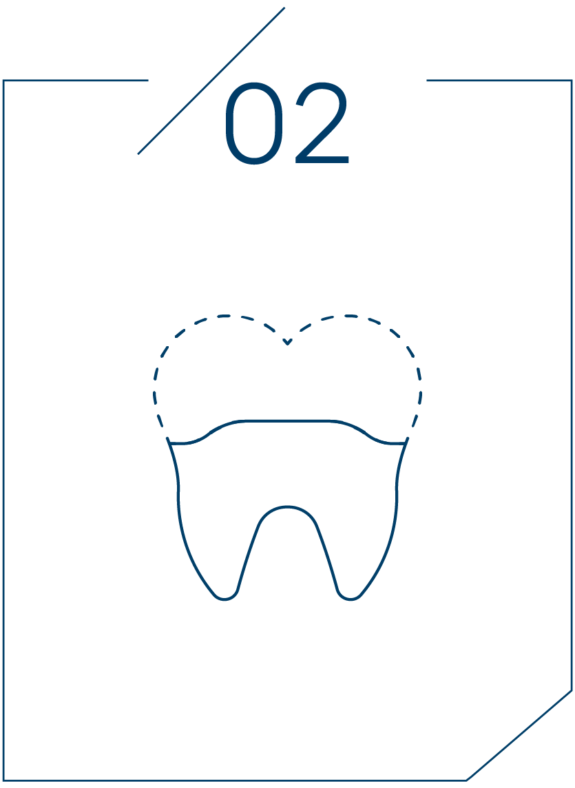 <span style="letter-spacing: -0.8px;"><strong>2단계 치아 삭제 및 본뜨기</strong></span>