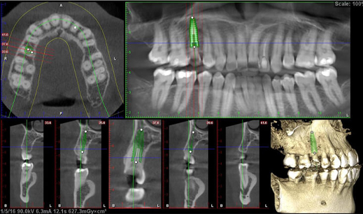 3차원 CT 