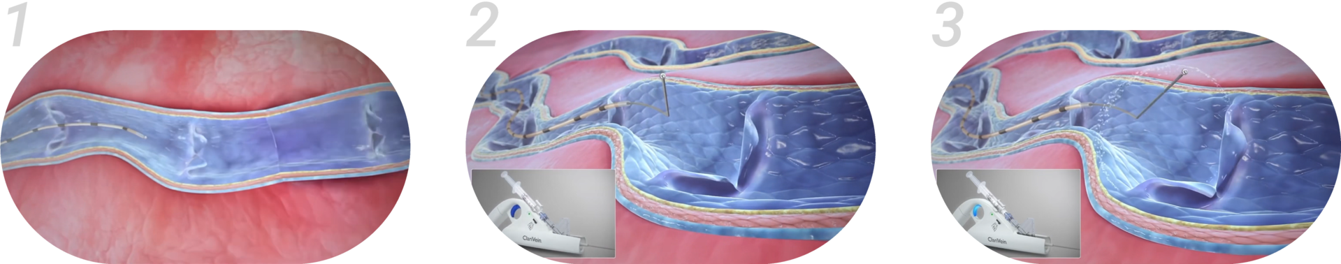 출처 :   Merit Medical. (2021. 4. 14). ClariVein® IC Infusion Catheter: Introduction [Video]. YouTube. | https://www.youtube.com/watch?v=0JdaxkGNk6o