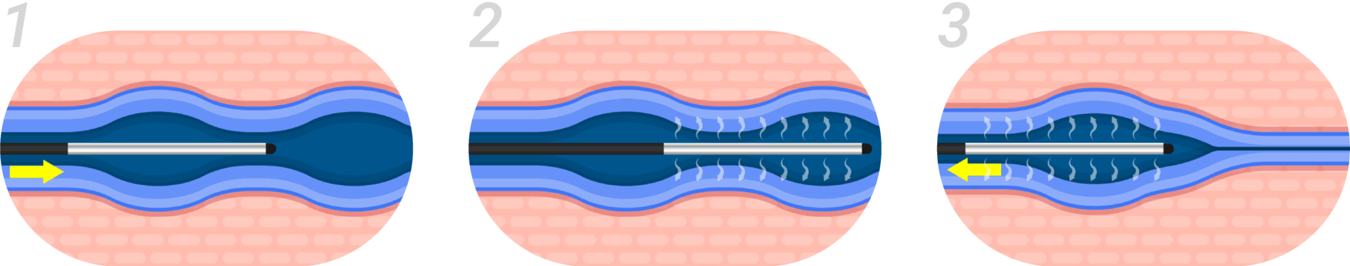 출처 : islandcardiovascular.com
