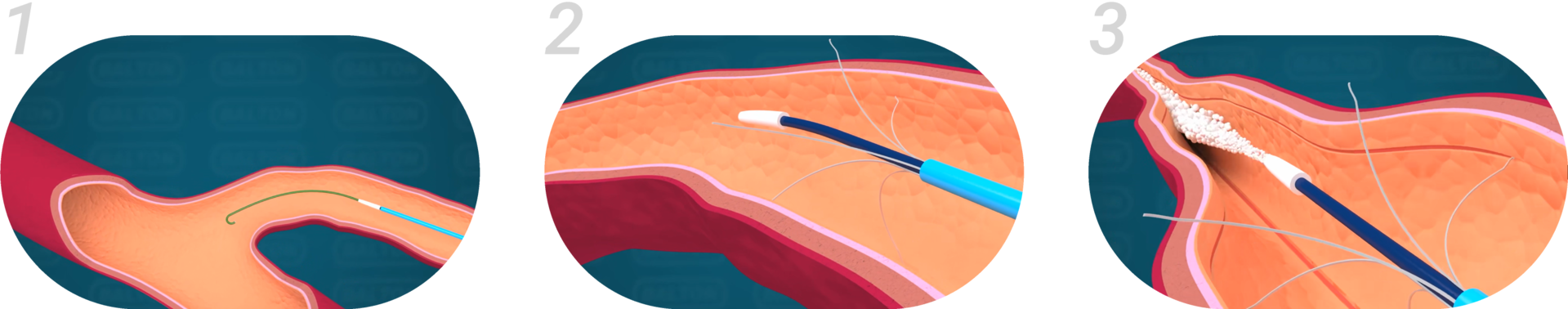 출처 :    Ashok Aggarwal. (2017. 6. 22). MOCA FOR VARICOSE VEIN- FLEBOGRIF [Video]. YouTube. | https://www.youtube.com/watch?v=qT4lAbWmwUw