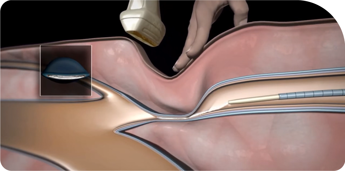 출처 :  Doctor House Cardio-Vascular Center. (2020.7.18). Super Glue Treatment for Varicose Veins[Video]. YouTube. | https://www.youtube.com/watch?v=6MDMMoTV6NE