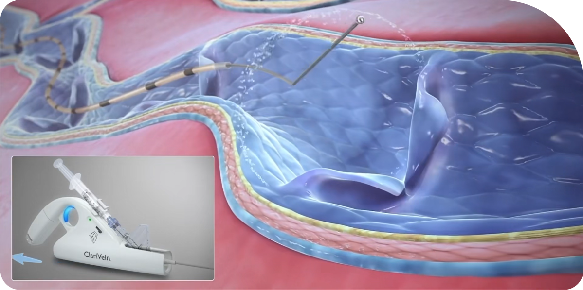 출처 :   Merit Medical. (2021. 4. 14). ClariVein® IC Infusion Catheter: Introduction [Video]. YouTube. | https://www.youtube.com/watch?v=0JdaxkGNk6o