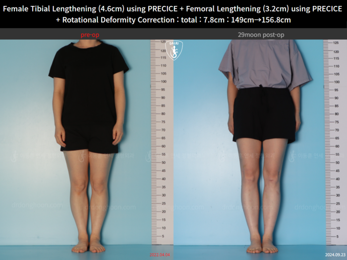 Femoral + tibial lengthening, 4.6 cm gained