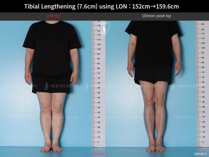 Tibial lengthening, 7.6 cm gained