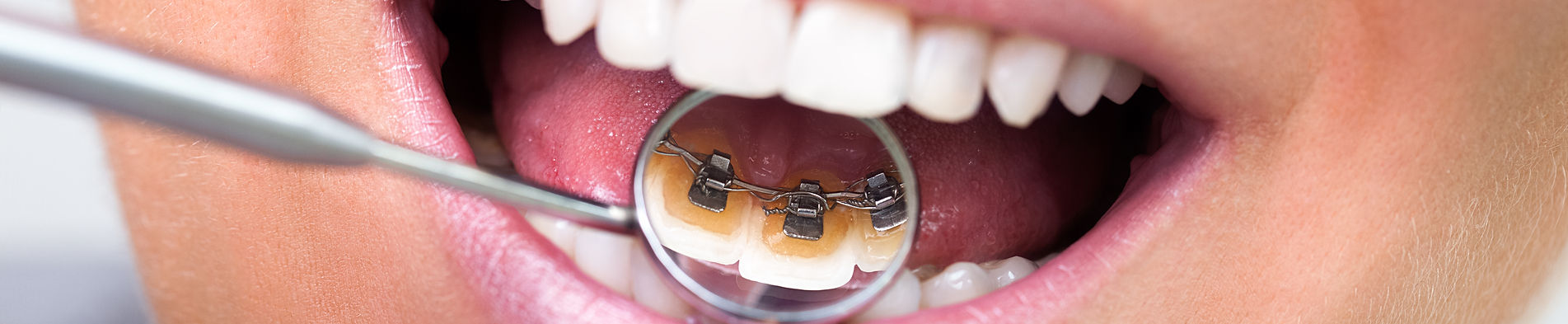 <span style="font-size: 48px; font-weight: bold;">전문가 미백</span>