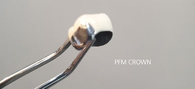 포세린 크라운은 내부는 금속, 겉은 도자기 재질로 되어있어<br>  투명도가 낮아 탁한 색상과 경계에 금속이 비칠 수 있음