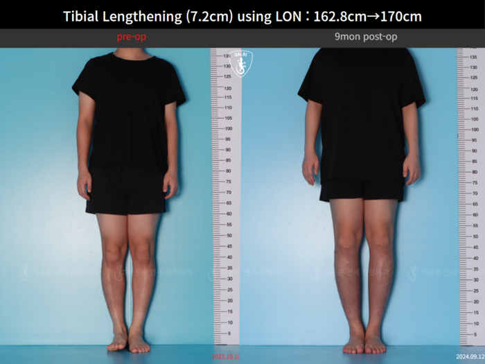 Tibial lengthening, 7.2 cm gained