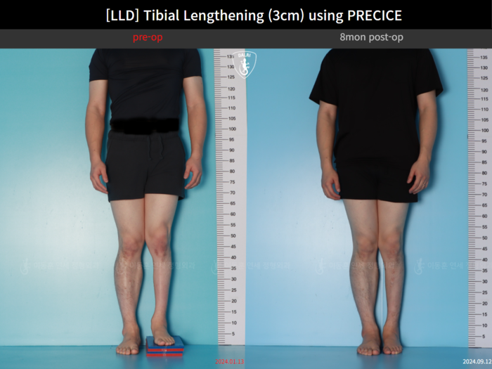 Tibial lengthening, 3 cm gained