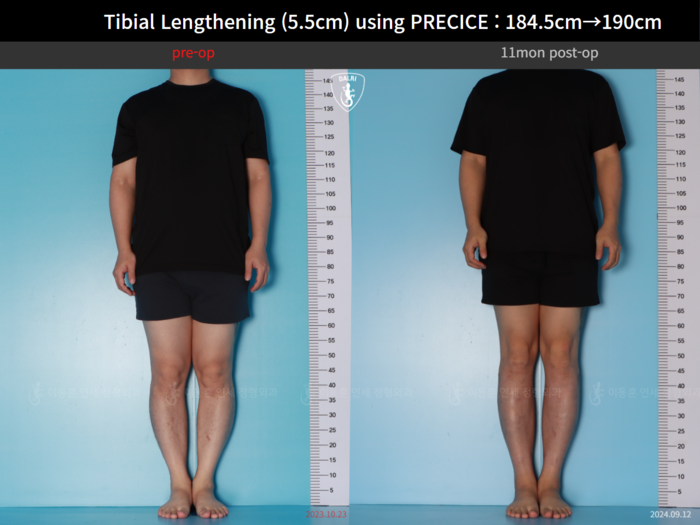 Tibial lengthening, 5.5 cm gained
