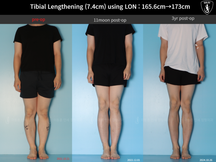 Tibial lengthening, 7.4 cm gained