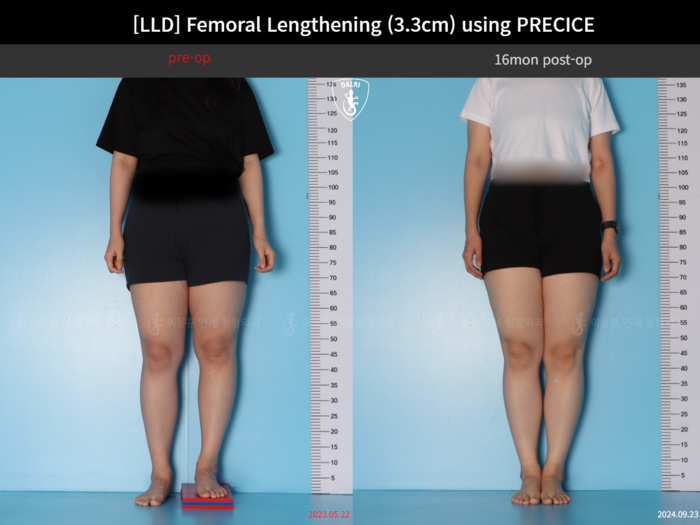 Femoral lengthening, 3.3 cm gained