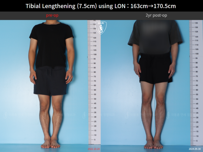 Tibial lengthening, 7.5 cm gained