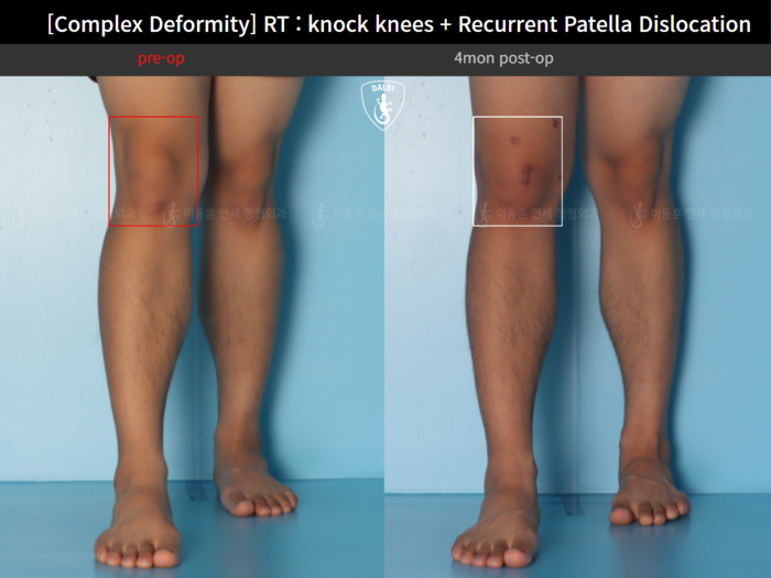 Recurrent patella dislocation