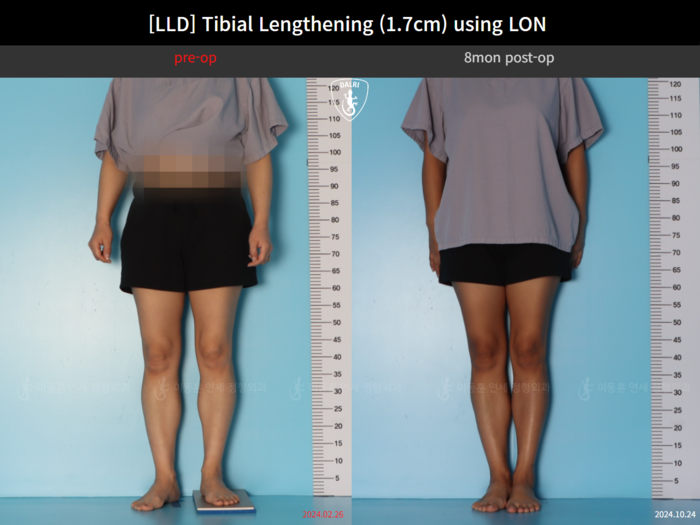 Tibial lengthening, 1.7 cm gained