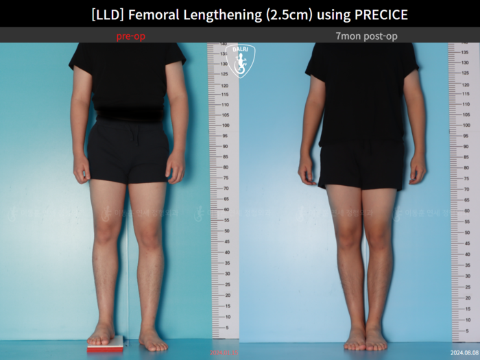 Femoral lengthening, 2.5 cm gained