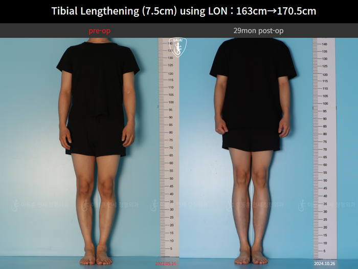 Tibial lengthening, 7.5 cm gained
