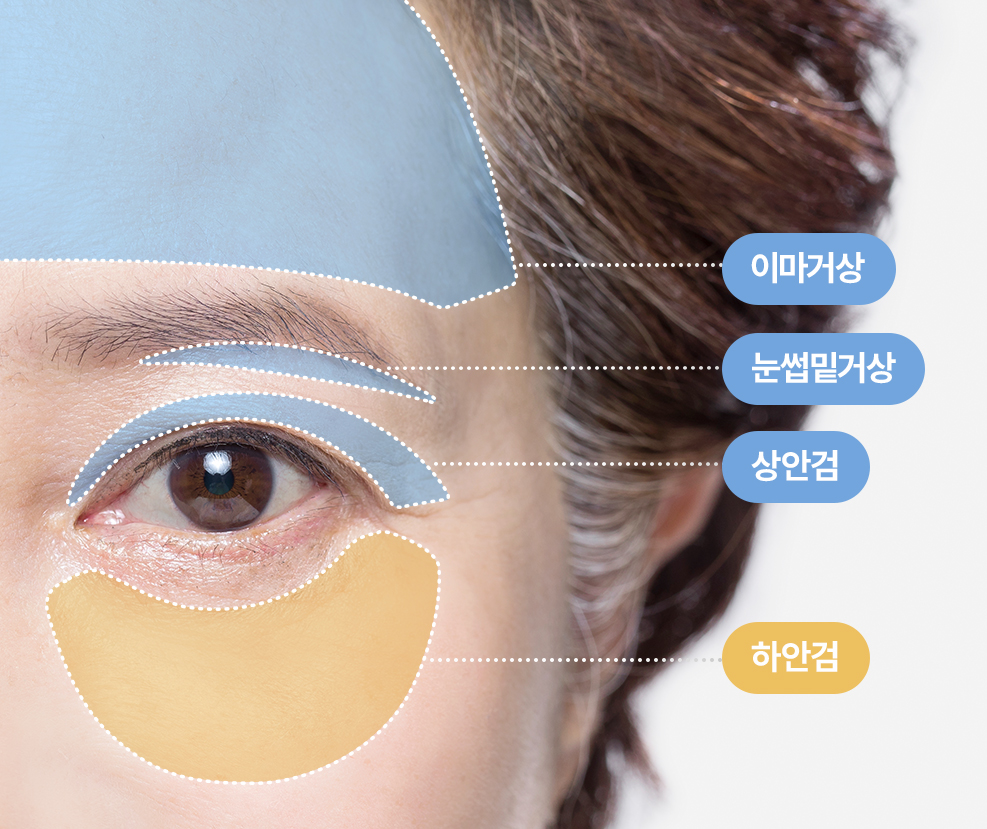 리드성형외과-이마거상-눈썹밑거상-상안검-하안검