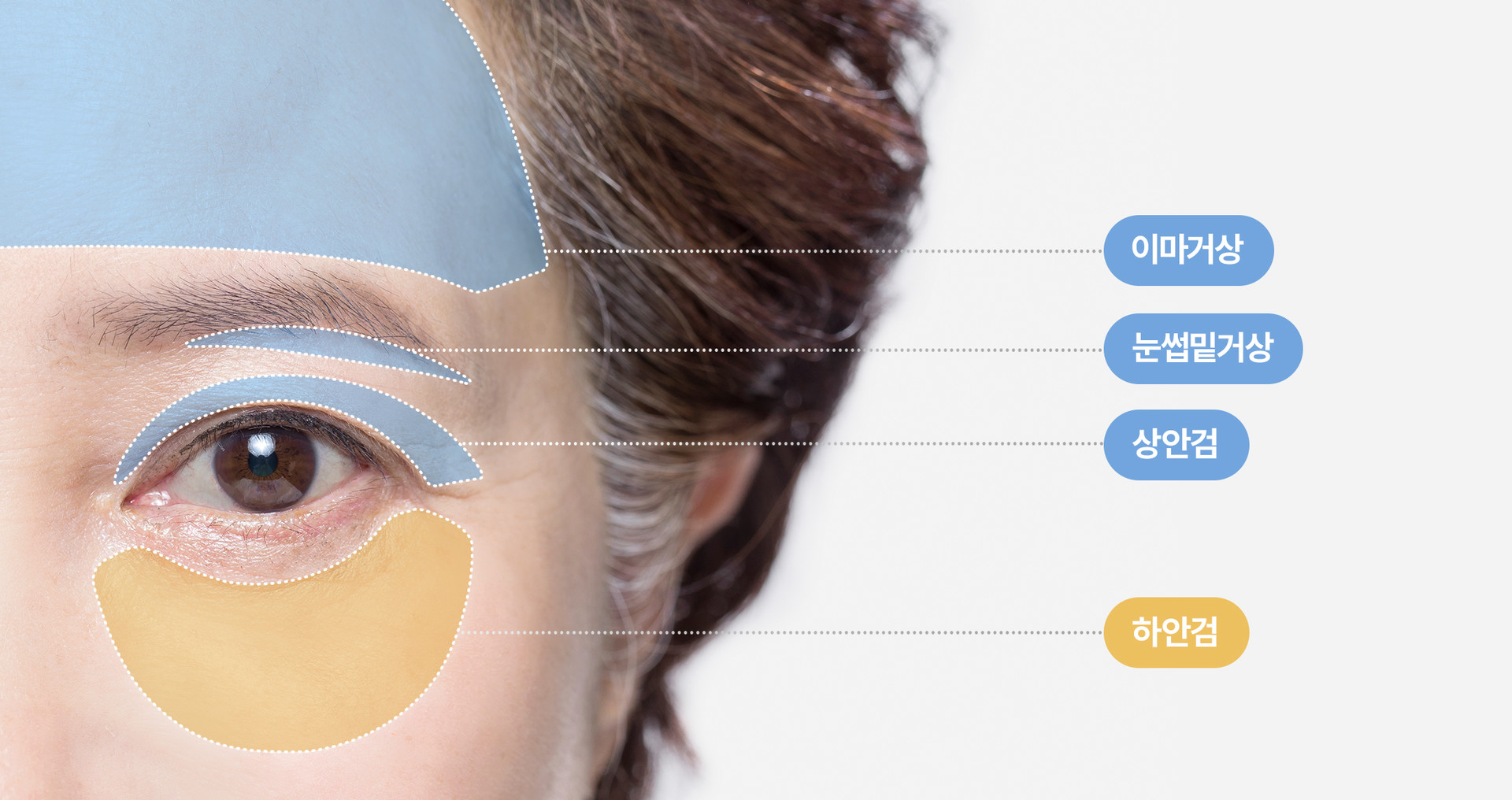 리드성형외과-이마거상-눈썹밑거상-상안검-하안검