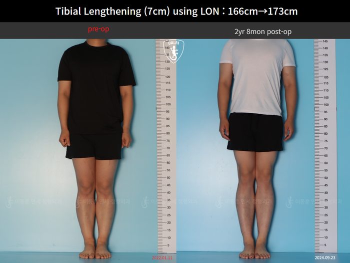 Tibial lengthening, 7 cm gained