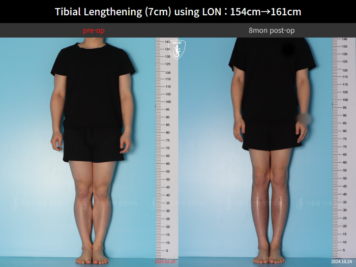 Tibial lengthening, 7 cm gained