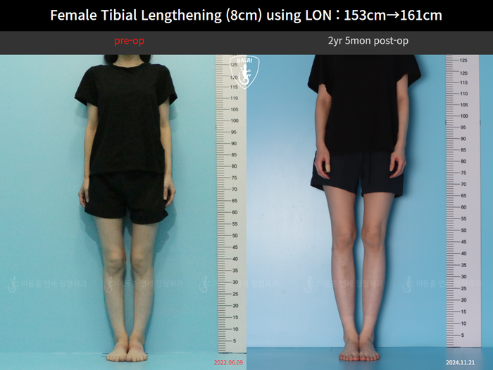 Tibial lengthening, 8 cm gained