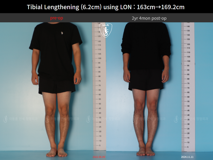 Tibial lengthening, 6.2 cm gained