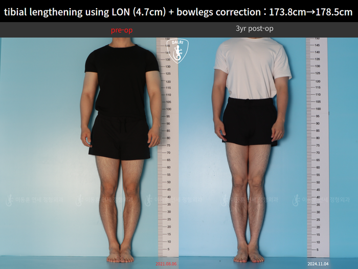 Tibial lengthening, 4.7 cm gained