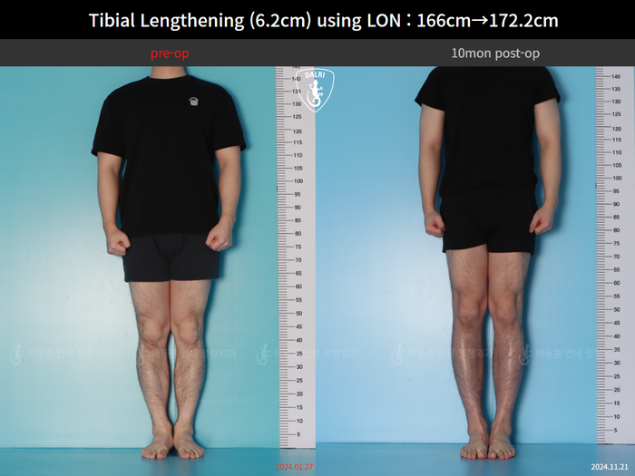 Tibial lengthening, 6.2 cm gained
