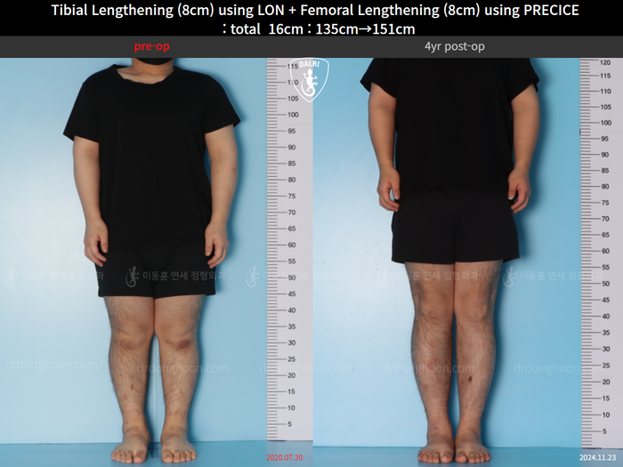 Femoral + tibial lengthening, 8 cm gained
