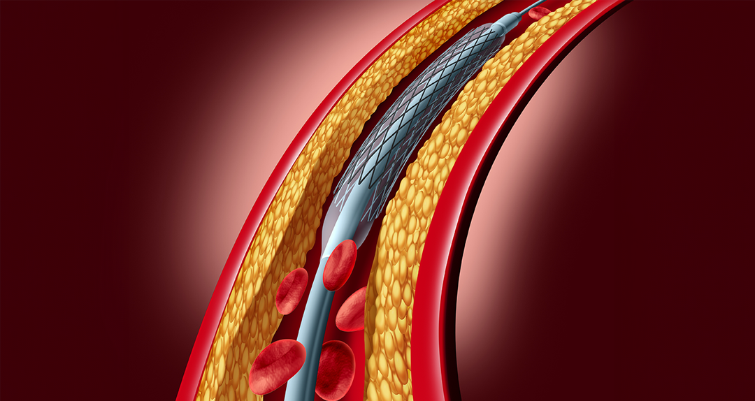 <p><br></p><p style="text-align: left; margin-left:30px;">     <span style="font-size: 20px; color: #b32124; ">         <strong>CHOICE 02.</strong>     </span> </p>  <p style="text-align: left; margin-left:30px;">     <span style="font-size: 28px; color: #363636;"><strong>스텐트 삽입</strong></span> </p>