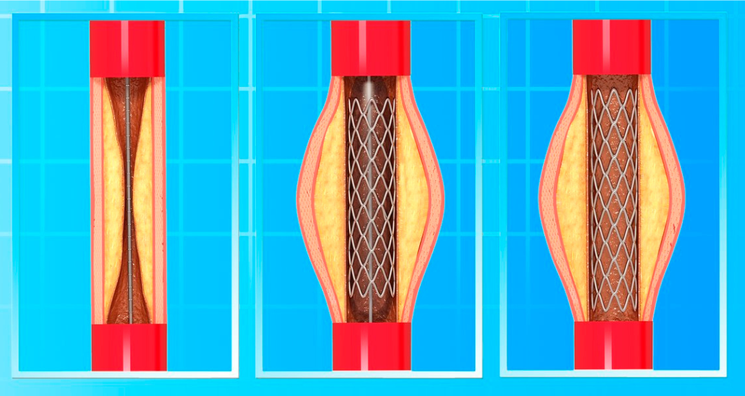 <p><br></p><p style="text-align: left; margin-left:30px;">     <span style="font-size: 20px; color: #b32124; ">         <strong>CHOICE 01.</strong>     </span> </p>  <p style="text-align: left; margin-left:30px;">     <span style="font-size: 28px; color: #363636;"><strong>풍선혈관확장술(PTA)</strong></span> </p>