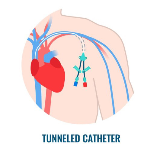 <p><br></p><p style="text-align: left; margin-left:30px;">     <span style="font-size: 20px; color: #b32124; ">         <strong>CHOICE 03.</strong>     </span> </p>  <p style="text-align: left; margin-left:30px;">     <span style="font-size: 28px; color: #363636;"><strong>투석용 카테터</strong></span> </p>